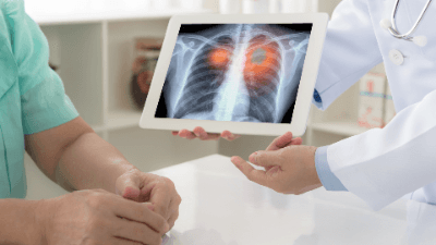 Lung Cancer & Mesothelioma Cases: Legal & Medical Insights 