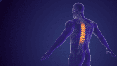 Protrusion Conclusion: Acute or Pre-Existing?